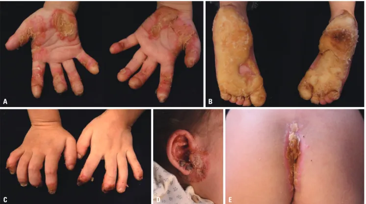 Fig. 1. Skin lesions at the initial clinical presentation. Diffuse severe keratoderma on (A) the palmar and (B) the plantar surfaces