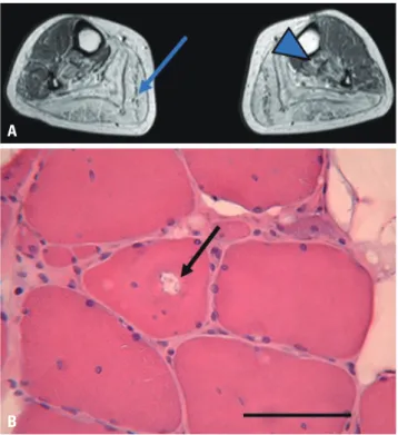 Fig. 1. Radiologic and pathologic findings of muscular dystrophy pa- pa-tients. (A) Radiologic finding of patient 1