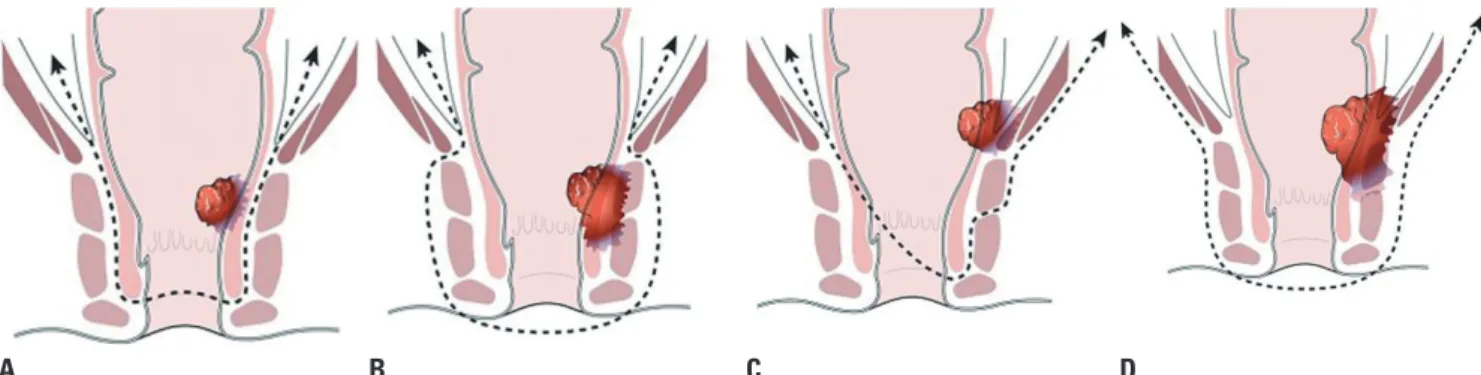 Fig. 1. Schematic of surgical options for low lying rectal cancer. Adapted from Noh, et al