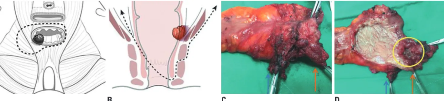 Fig. 2. Schematic of hemilevator excision (HLE) and specimen. (A and B) Adapted from Noh, et al