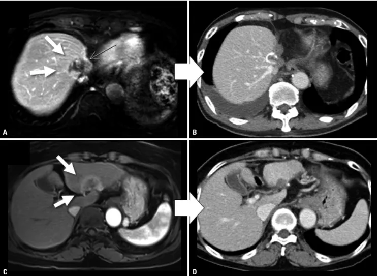 Fig. 1. CT scans of patient cases showing objective responses to SBRT of 60 Gy in 4 fractions for HCC