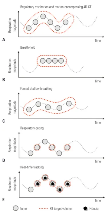 Fig. 2. Different motion management methods in RT. (A) The motion-en- motion-en-compassing method refers to the covering of all possible positions of the  moving tumor through the whole breathing cycle using 4D-CT images