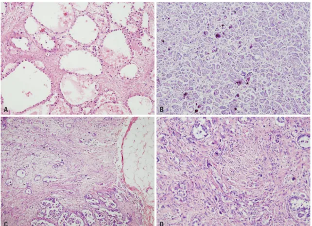 Fig. 1. Histologic grades of O-CCC. (A and B) Low grade O-CCC. (A) tubulocystic or alveolar patterns are the most common patterns seen in low grade  tumor