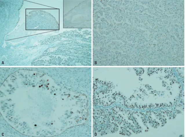 Fig. 2. ARID1A expressions in O-CCC. (A) In endometriosis, nuclear staining occurs along the epithelial lining (inlet), but CCC shows complete loss of  ARID1A (DAB, ×40)