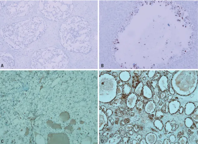 Fig. 3. HNF1β and ERβ expressions in O-CCC. (A and B) HNF1β expression. (A) Complete loss of HNF1-β is rarely found in CCC