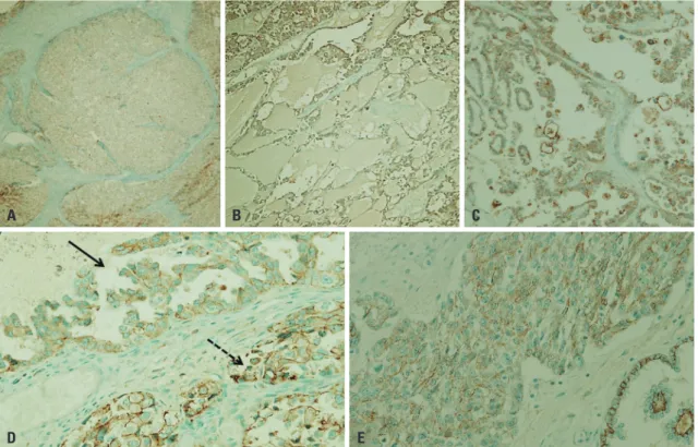 Table 2. Clinico-Pathologic Characteristics of ARID1A-Expressing Ovarian Clear Cell Carcinoma 