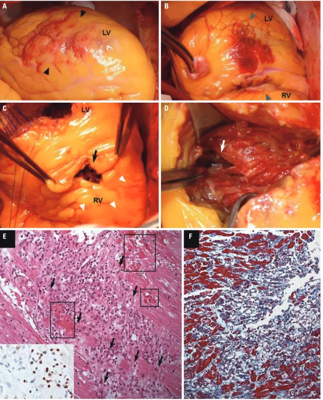 Fig. 2. (A and B) An anterolateral (black triangle) and inferior (gray triangle) wall of the LV have necrotic changes with hemorrhage