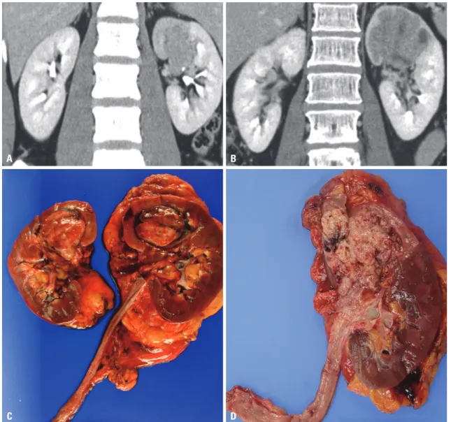 Fig. 1. (A and B) Pathologically proven infiltrative renal cell carcinoma and transitional cell carcinoma in preoperative multi-detector computed tomogra- tomogra-phy