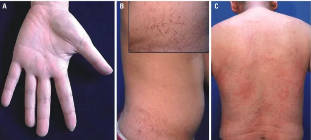 Fig. 1. FLG mutations detected in patients with atopic dermatitis. (A) A het- het-erozygous deletion mutation, 3321delA, in FLG repeat 2 in exon 3 was  identified in patient no
