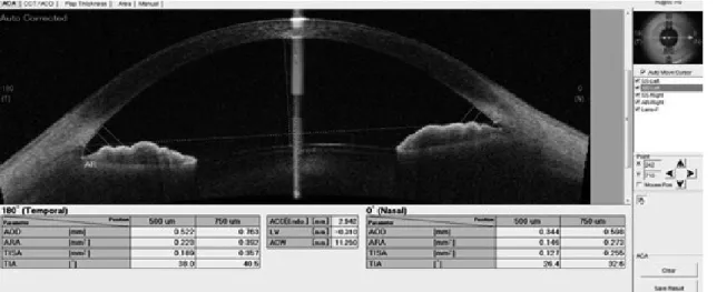 Fig. 1. Angle parameters (AOD 500 and 750, TISA 500 and 750, ARA 500 and 750, and TIA 500 and 750) were generated by the swept source optical co- co-herence tomography’s intrinsic program after marking the position of the scleral spur