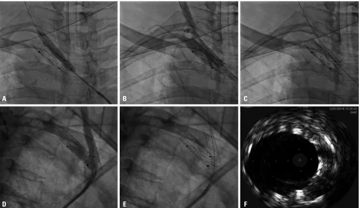 Fig. 4. Angiographic images during rewiring and stenting of the left common carotid artery (LCCA) (these images are all mirrored image of this patient with  situs inversus; that is, the “right brachiocephaic trunk in images” actually are left ones)