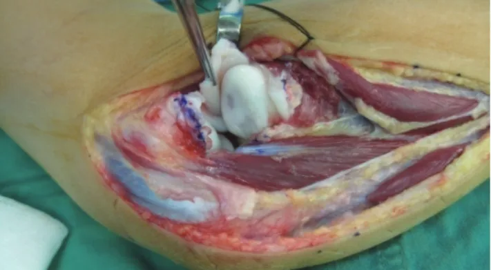 Fig. 2. The radial head is surrounded with dense fibrous scar tissue pre- pre-venting reduction.