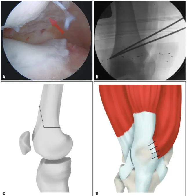 Fig. 1. (A) Biplane distal femur osteotomy and medial reefing procedure arthroscopic superiorlateral view-subluxed patellar target point is above the lat- lat-eral epicondyle of distal femur biplane osteotomy latlat-eral release and medial reefing