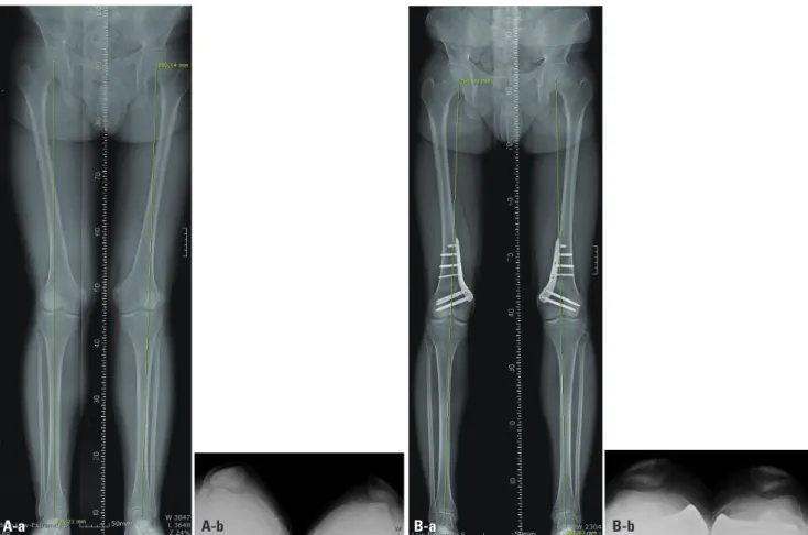 Fig. 2. (A-a) Preoperative standing, full length, hip-to-ankle radiograph of a 21-year-old male patient showing bilateral genu valgus deformity as shown by  the weight bearing lines (green line) and subluxation of patellar both