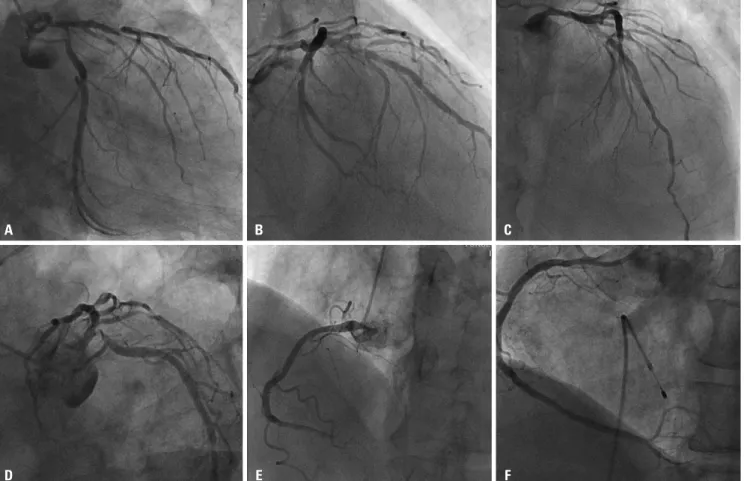 Fig. 1. Initial angiography is shown. There were significant stenosis of left main coronary artery, proximal left anterior descending artery with heavy calci- calci-fication and ostium to proximal left circumflex (A-D)