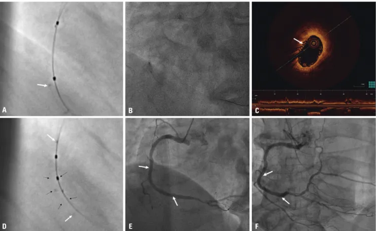 Fig. 3. After BVS implantation. (A) Stent boost subtract image, showing definite edge detection for safe overlapping of two BVSs (arrow: overlapping  site)