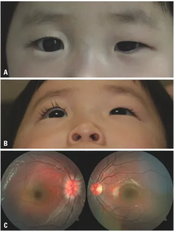 Fig. 1. Clinical photographs and fundus photographs. (A and B) Clinical  photographs demonstrate right enophthalmos with ipsilateral upper  and lower lid retraction and entropion