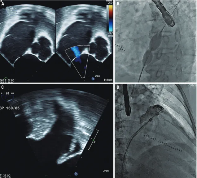 Fig. 1. Two dimensional TEE image of ASD (A). Fluoroscopic evaluation of ASD during expansion of the sizing balloon (B)