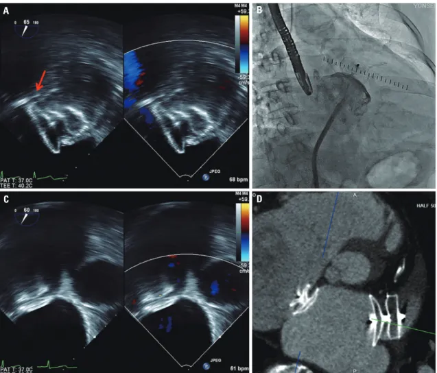 Fig. 2. The deployed left atrial appendage closure device (ACP 30 mm) was confirmed with transesophageal echocardiographic imaging (arrow: left  circumflex artery) (A) and fluoroscopic imaging (B)