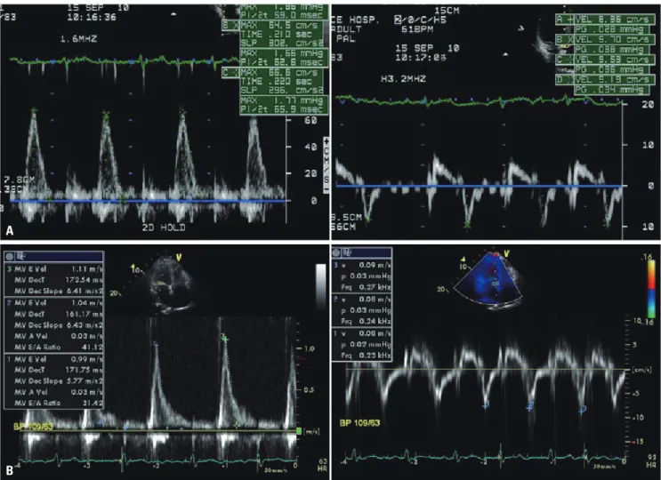 Fig. 4 shows the Kaplan-Meier survival curves for AF recur-