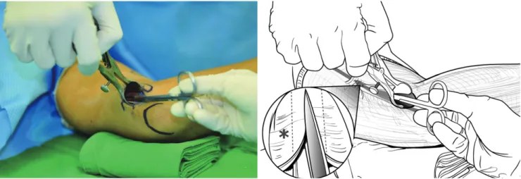 Fig. 1. While viewing the proximal compressing structures of the ulnar nerve using a long nasal speculum, the brachial fascia and arcade of Struthers (*)  were released under direct visualization.