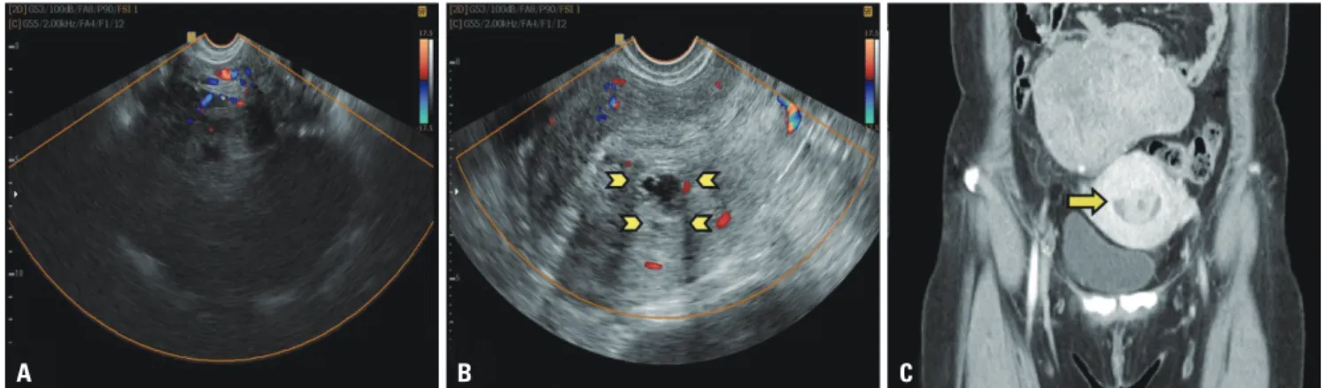 Fig. 1. Preoperative ultrasonographic and computed tomography findings. (A) A 13×12 cm solid hypoechoic mass with multiple cystic lesions was noted  on the right pelvic area accompanied by blood flow shadow
