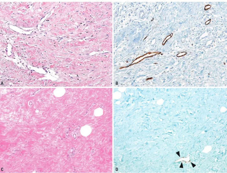 Fig. 1. Lymphangiogenesis in fibrous stroma in tumor with high elasticity value and low elasticity value