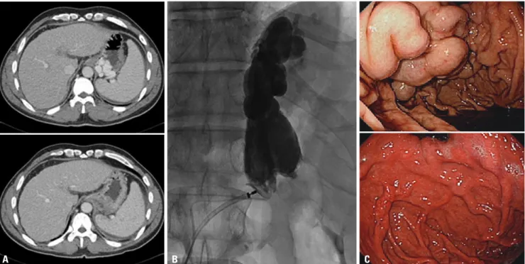 Fig. 2. Fundal GV in a 46-year-old man with massive hematemesis. (A) Contrast-enhanced axial CT images obtained before and after PARTO show com- com-pletely disappeared fundal GV