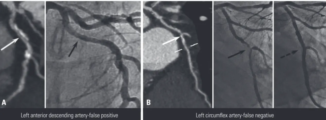 Fig. 3. Example of discordance between the coronary computed tomographic angiography (CCTA)-indicated therapy and the actual conducted therapy