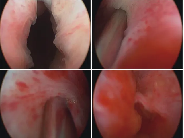 Fig. 1. Before injection, the external urethral sphincter was open. Solution and adipose tissue was injected into the rhabdosphincter and submucosal  space at the 5 and 7 o’clock positions and at the 4, 6, and 8 o’clock positions to facilitate complete coa