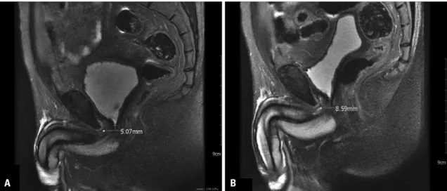 Fig. 2. In case of patient E, MRI showed an increase in the functional urethral length (from 5.07 to 8.59 mm) between the lower rim of the pubic bone and  bladder neck 4 weeks after injection (A: baseline, B: 4 wks after injection).
