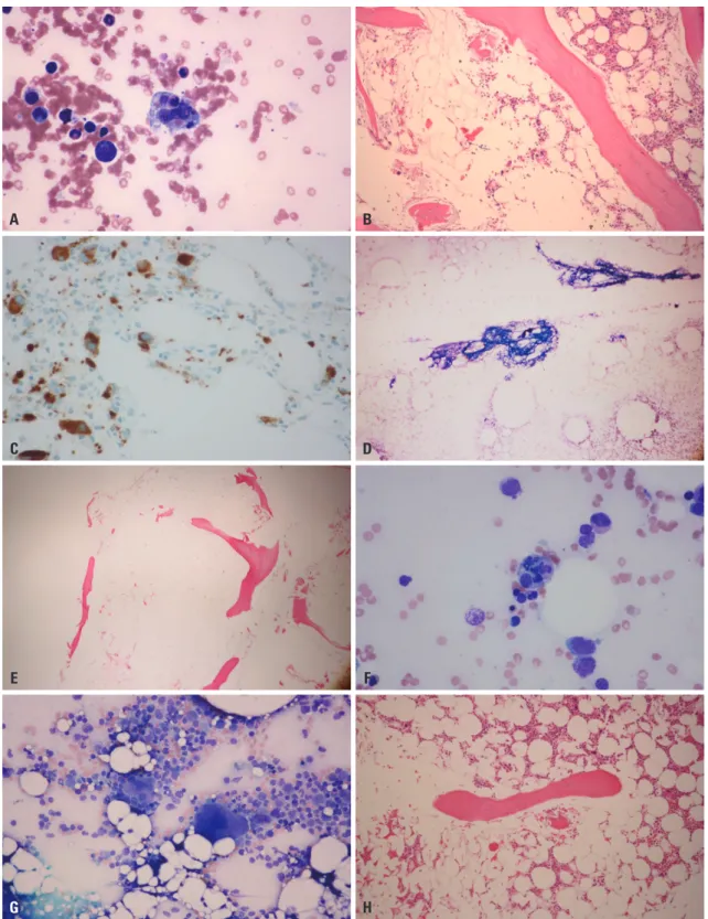 Fig. 1. Findings of bone marrow (BM) aspirate and section of case 1 (A, B, and C), 2 (D and E), and 3 (F, G, and H)