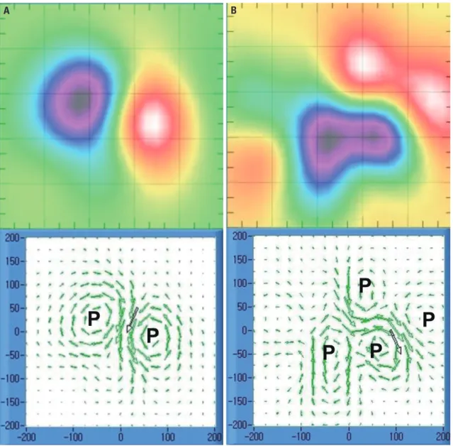 Fig. 4 shows the Kaplan-Meier survival curves for MACE in  patients with dipole and dipole patterns