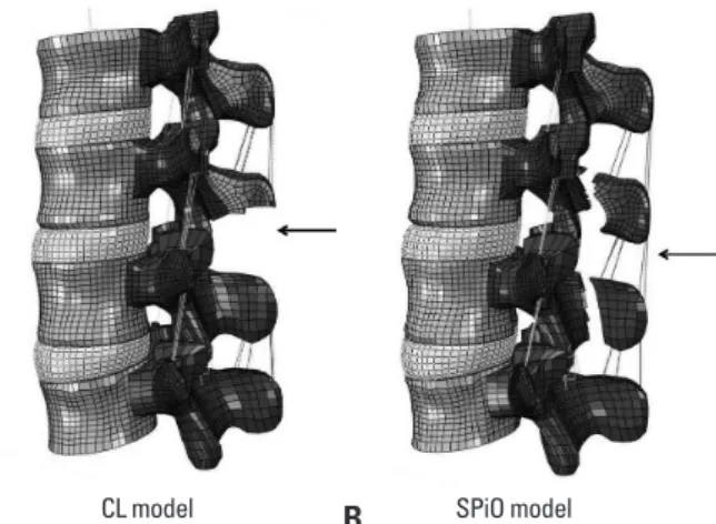 Fig. 1. Finite element models. (A) Conventional laminectomy (CL) model; ar- ar-row indicates the sacrifice of posterior ligament complex