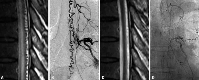 Fig. 1. Illustrative case (Case 5). A 49-year-old male presented with progressive motor weakness for 18 months