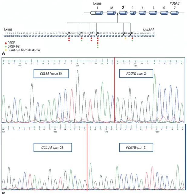 Fig. 1. (A) Schematic presentation of variable positions of collagen type I alpha 1 (COL1A1) breakpoints in the COL1A1-platelet-derived  growth factor beta (PDGFB) fusion gene