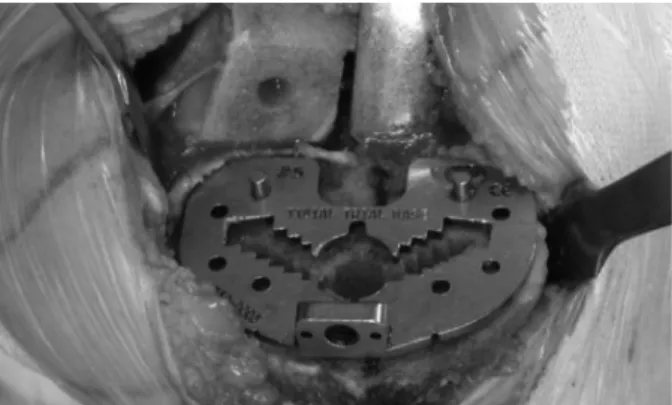Fig. 5. Tibial plate is inserted as synchronized with marked tibial AP axis. 