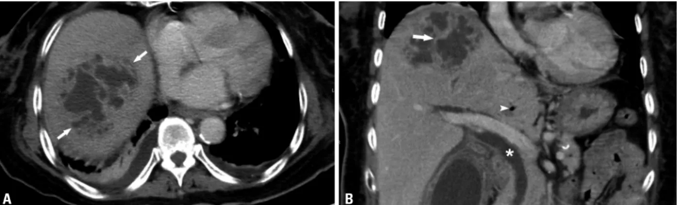 Fig. 1. A 72-year-old woman with non-KPLA (caused by Enterococcus) who presented with fever and right upper quadrant pain for 7 days