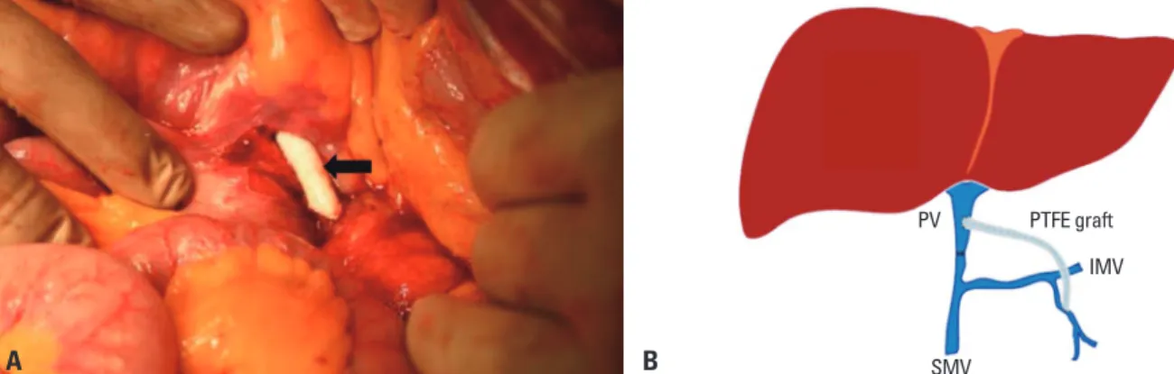 Fig. 3. Postoperative computed tomography at post operative 7 days (A) and 27 months (B) shows that the polytetrafluoroethylene graft has no thrombosis  and no anastomotic stricture