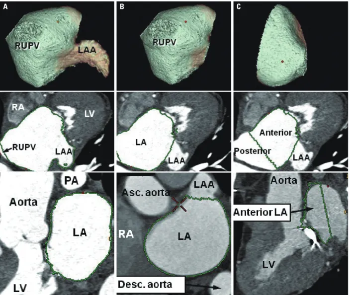 Fig. 1. Three-dimensional measurement of LA volumes using volume-rendering imaging. Green demarcation lines indicate the extents of measurement for  each compartment including (A), entire LA (right-anterior view); (B) LAA-extracted LA (right-anterior view)