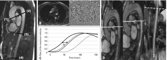 Fig. 1. (A) Contrast enhanced MR imaging showing the aorta in the long axis. Each level perpendicular to the aorta was applied for gradient echo imaging  with velocity encoding