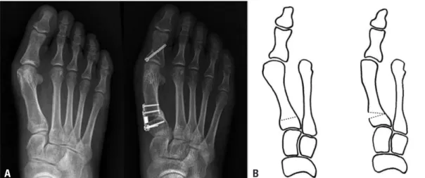 Fig. 2. Preoperative (left) and 12-month postoperative (right) weight-bearing anteroposterior radiographs (A) and schematic drawings (B)  of a proximal opening wedge osteotomy utilizing an oblique osteotomy
