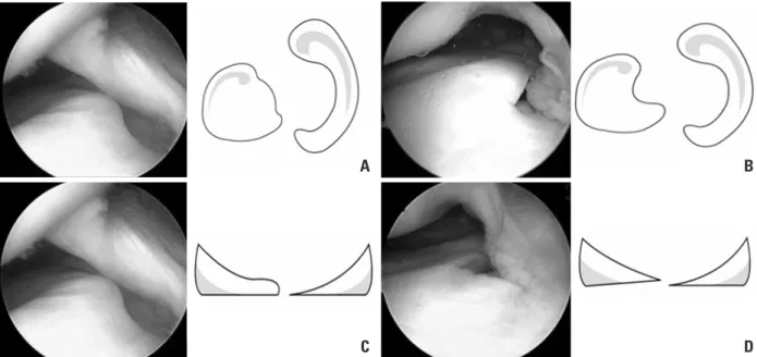 Fig. 1. Classification of the shape of complete discoid lateral meniscus based on the arthroscopic morphology of the medial edge