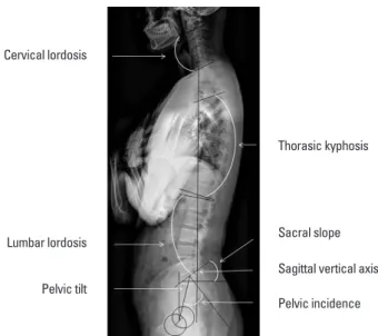 Fig. 3. Radiologic parameters evaluated in this study. Cervical lordosis  (Cobb angle between caudal endplate of C2 and caudal endplate of C7),  thoracic kyphosis (Cobb angle between cranial endplate of T4 and caudal  endplate of T12), lumbar lordosis (Cob