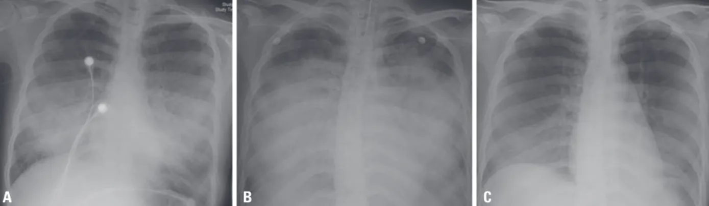 Fig. 1. Chest X-ray features of the patient: (A) when the symptoms presented, (B) immediately after intubation, (C) before discharge from the intensive care unit.