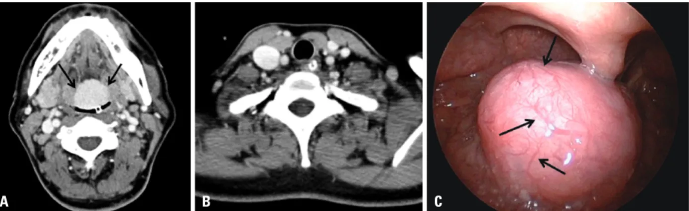 Fig. 1. (A) CT image showing a 3.0×2.5 cm enhancing mass (arrows) at the midline base of the tongue, above the epiglottis