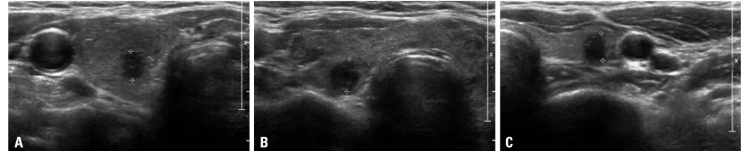 Fig. 1. Examples of nodules suspected as malignant on US findings. (A) A 6-mm suspicious nodule (delineated by electronic calipers) was found on the  right thyroid gland, and PTC was confirmed by surgical pathology