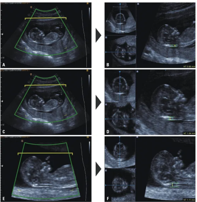 Fig. 1. Representative images of nuchal translucency (NT) thickness measurements using Volume NT TM  at three different magnifications: (A and B) au- au-tomated NT measurement with the fetal head and thorax occupying less than 50% of the image (method A); 