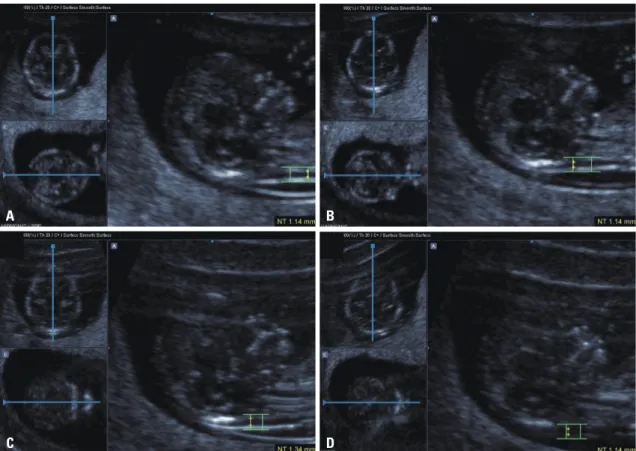 Fig. 2. Images of effects of tissue harmonic imaging (THI) and speckle reduction filter (SRF): (A) THI and SRF functions on; (B) THI function on; (C) SRF  function on; (D) both functions off.