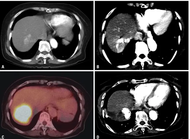 Fig. 1. Serial abdominal CT scan. (A) A 2.2-cm mass is shown in S7 of the liver (initial diagnosis, Jan-29-2011)